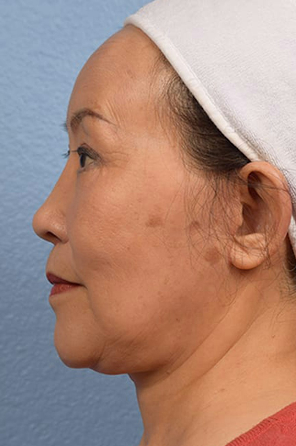 Facelift Before & After Gallery - Patient 401832 - Image 6