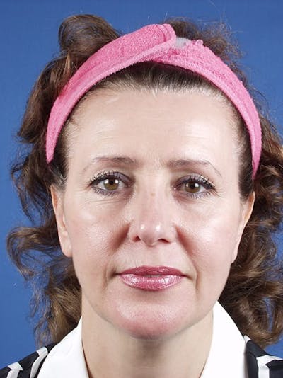 Facelift Before & After Gallery - Patient 255471 - Image 1
