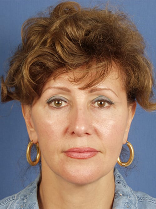 Facelift Before & After Gallery - Patient 255471 - Image 2