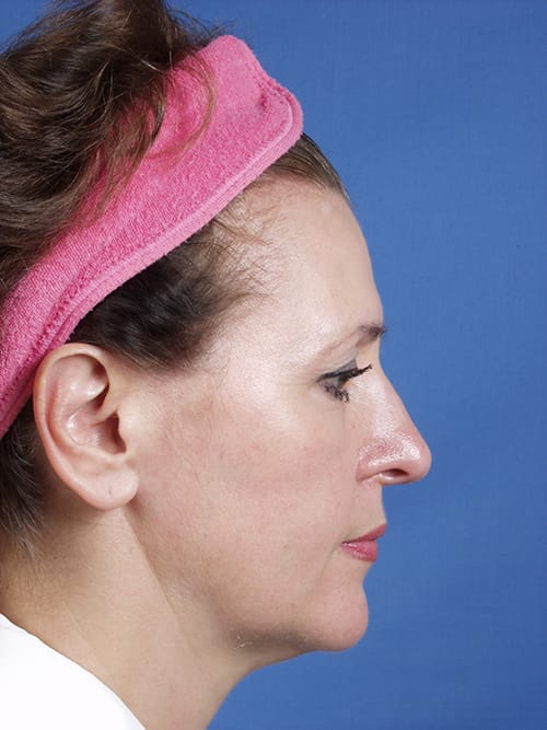 Facelift Before & After Gallery - Patient 255471 - Image 3