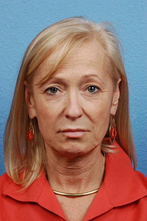 Facelift Before & After Gallery - Patient 423612 - Image 1