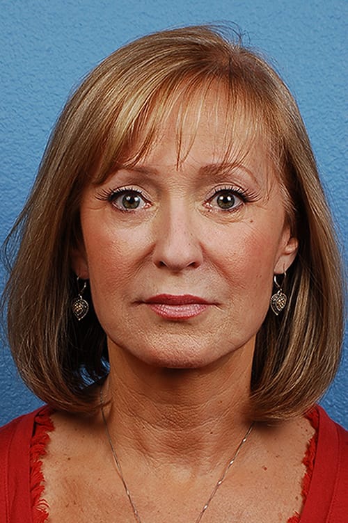 Facelift Before & After Gallery - Patient 423612 - Image 2