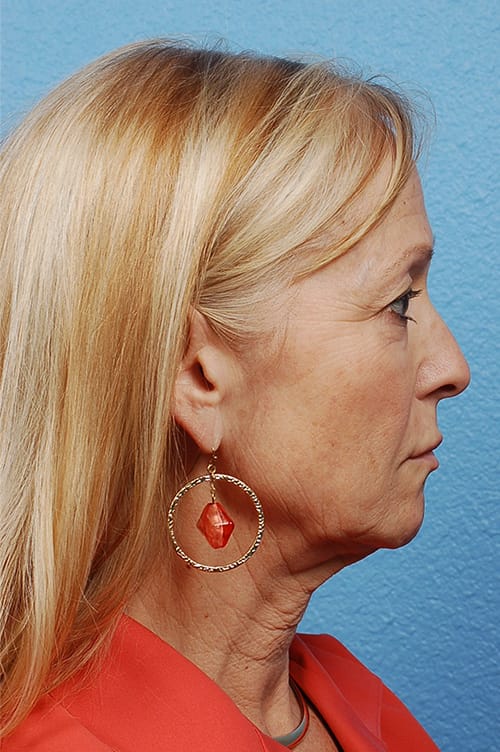 Facelift Before & After Gallery - Patient 423612 - Image 3