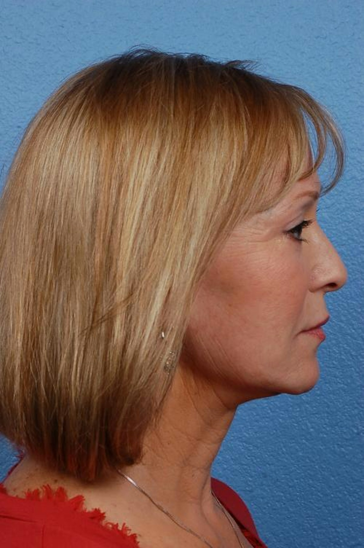 Facelift Before & After Gallery - Patient 423612 - Image 4