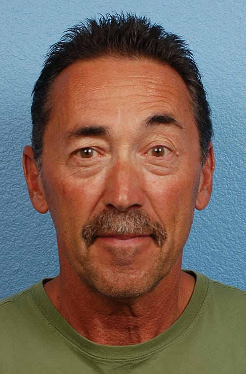 Hidden Patients Before & After Gallery - Patient 357550 - Image 2