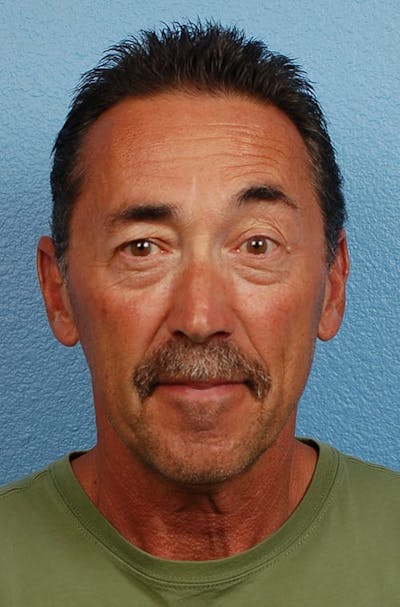 Facelift Before & After Gallery - Patient 559090 - Image 2