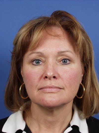 Facelift Before & After Gallery - Patient 242244 - Image 1
