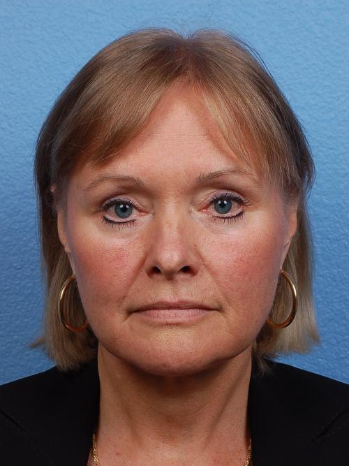 Hidden Patients Before & After Gallery - Patient 176103 - Image 2