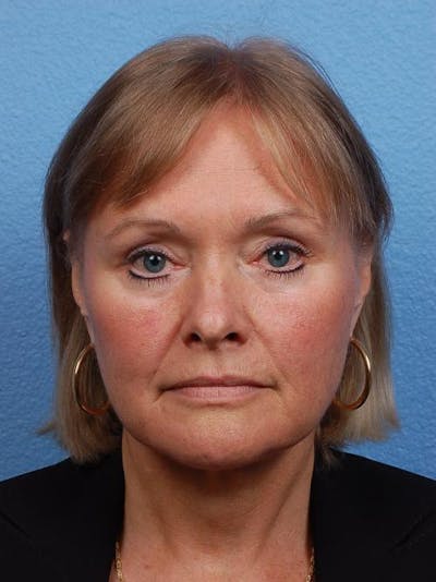 Facelift Before & After Gallery - Patient 242244 - Image 2