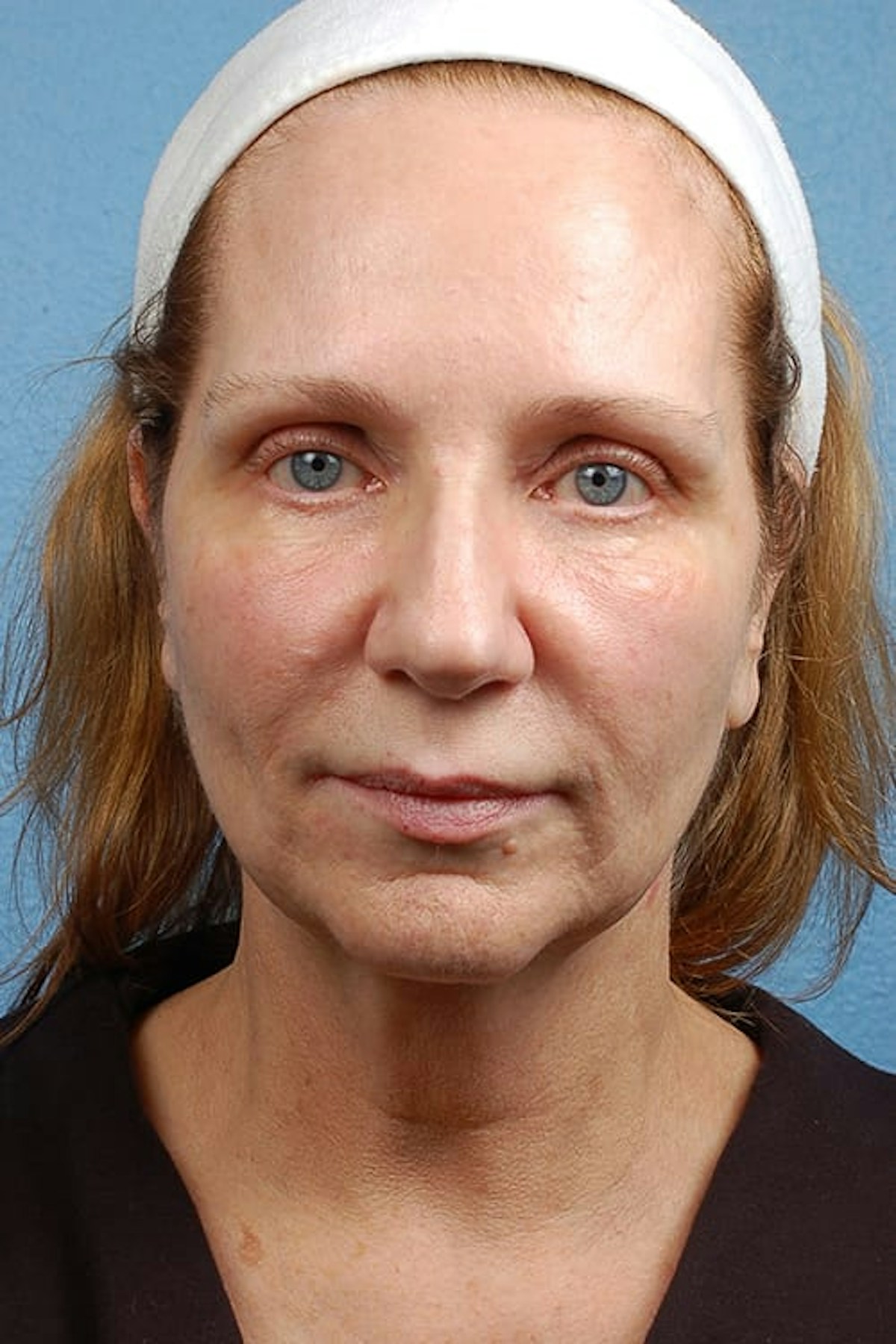 Facelift Before & After Gallery - Patient 858748 - Image 1