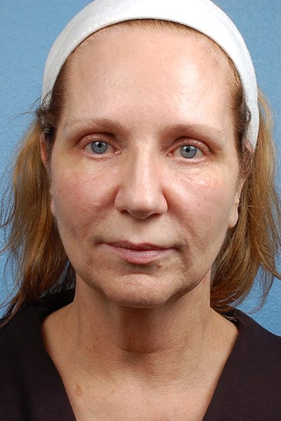 Facelift Before & After Gallery - Patient 858748 - Image 1