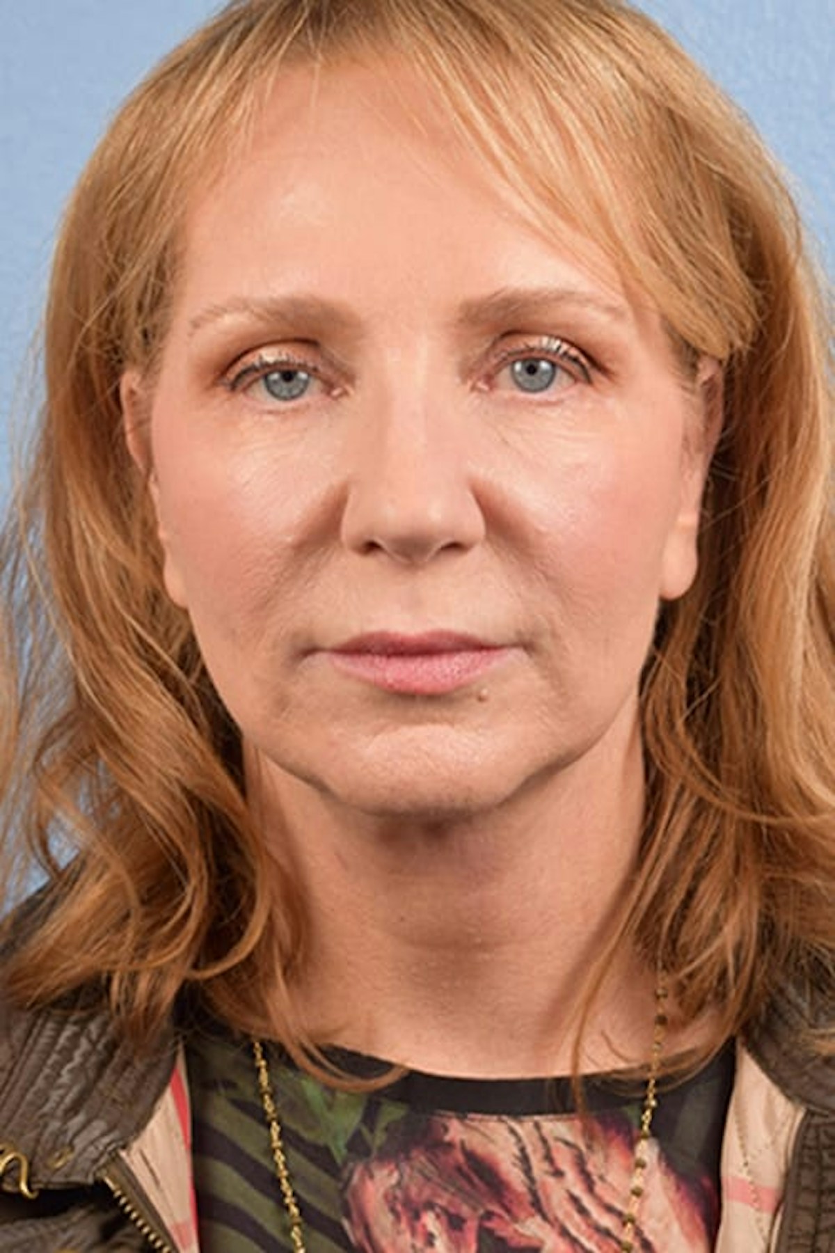 Facelift Before & After Gallery - Patient 858748 - Image 2