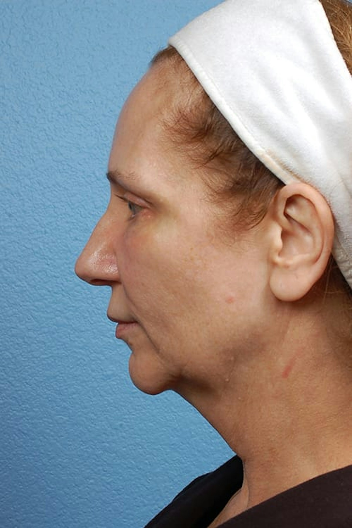 Facelift Before & After Gallery - Patient 858748 - Image 3