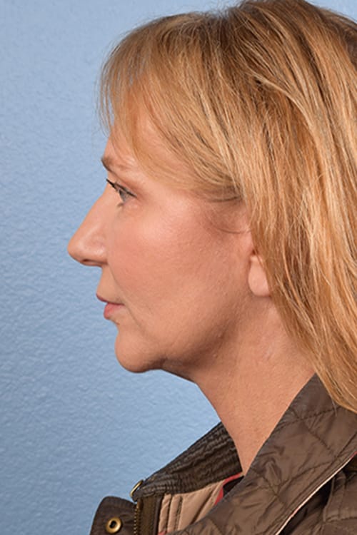 Hidden Patients Before & After Gallery - Patient 659782 - Image 4