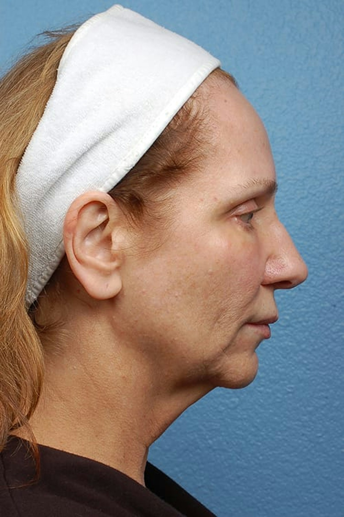 Facelift Before & After Gallery - Patient 858748 - Image 5