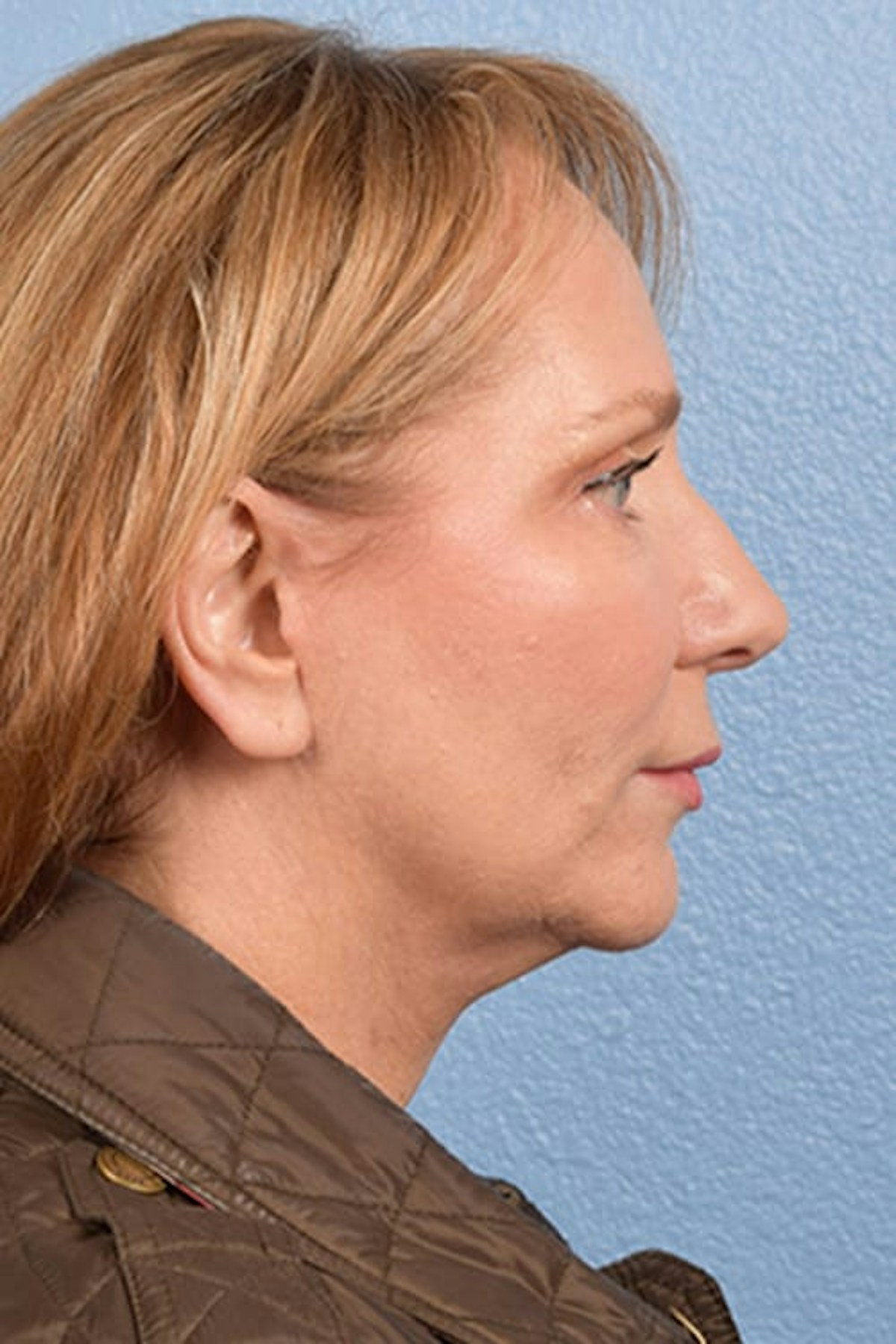 Facelift Before & After Gallery - Patient 858748 - Image 6