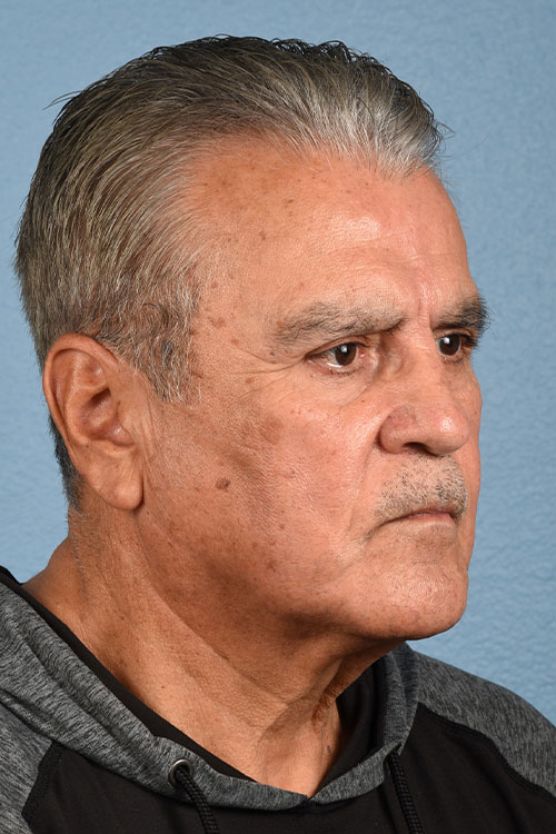 Hidden Patients Before & After Gallery - Patient 162682 - Image 1