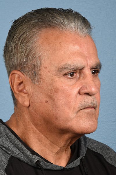 Neck Lift Before & After Gallery - Patient 151912 - Image 1