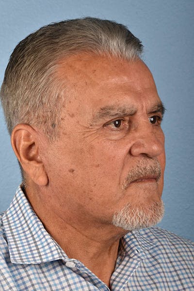 Neck Lift Before & After Gallery - Patient 151912 - Image 2