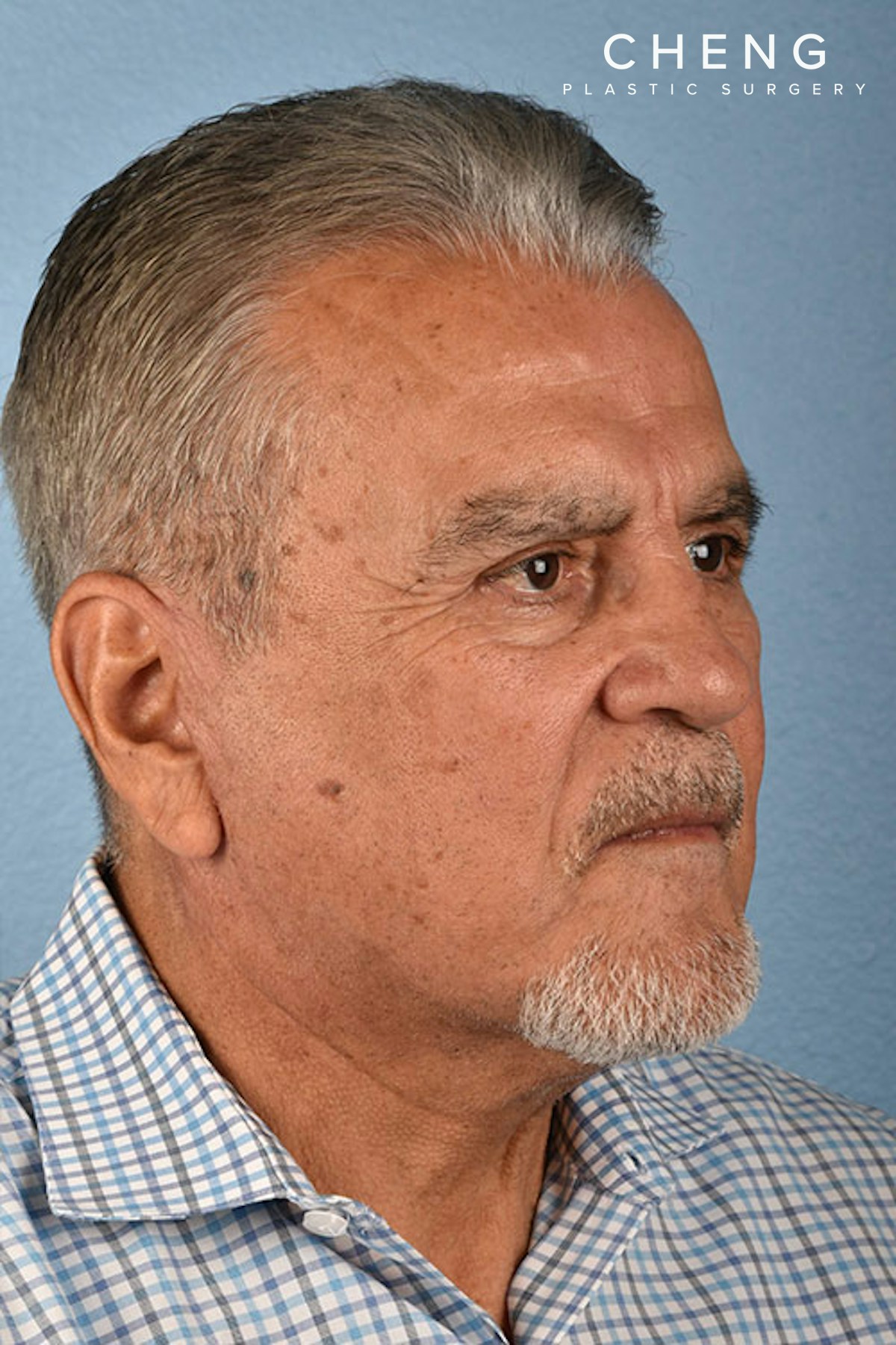 Hidden Patients Before & After Gallery - Patient 162682 - Image 2