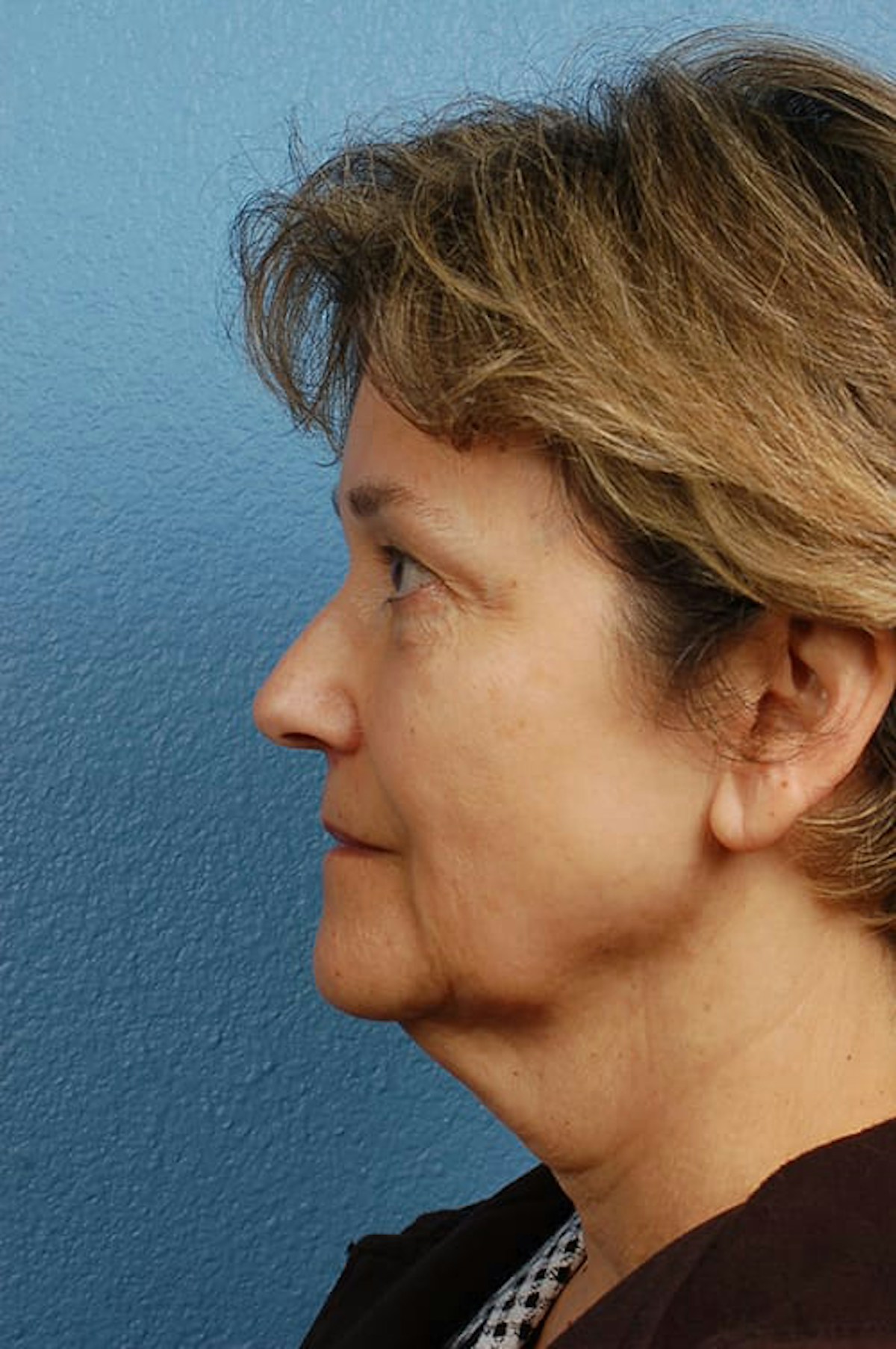 Facelift Before & After Gallery - Patient 976634 - Image 1