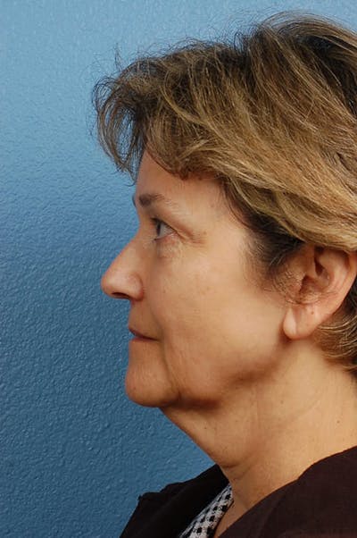 Facelift Before & After Gallery - Patient 976634 - Image 1