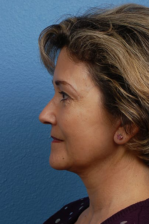 Facelift Before & After Gallery - Patient 976634 - Image 2