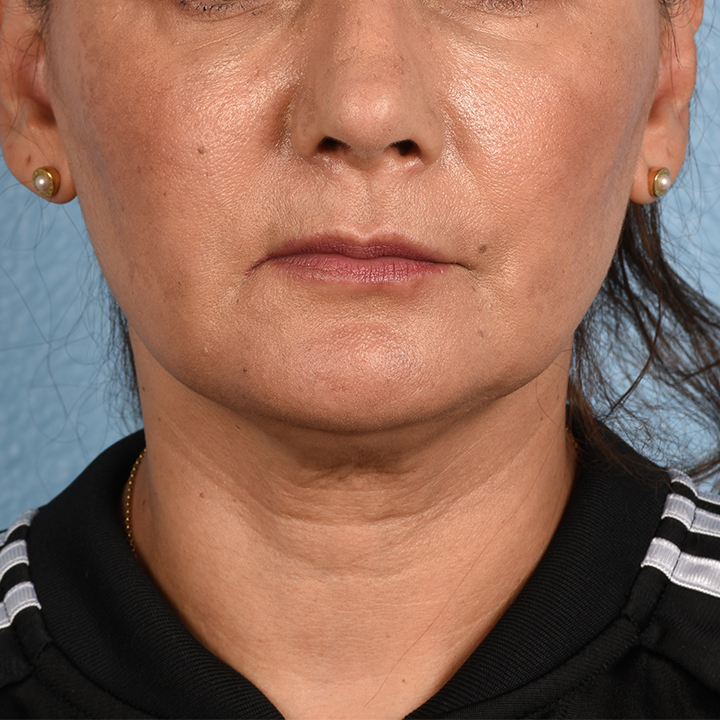 Facelift Before & After Gallery - Patient 230740 - Image 1
