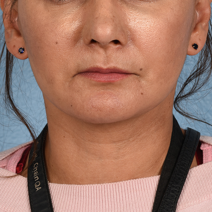 Facelift Before & After Gallery - Patient 230740 - Image 2