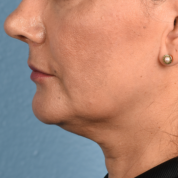 Facelift Before & After Gallery - Patient 230740 - Image 5