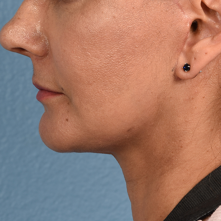 Facelift Before & After Gallery - Patient 230740 - Image 6