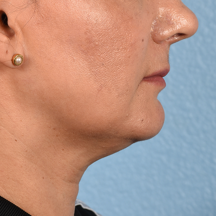 Facelift Before & After Gallery - Patient 230740 - Image 9