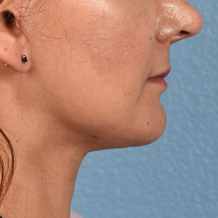 Facelift Before & After Gallery - Patient 230740 - Image 10