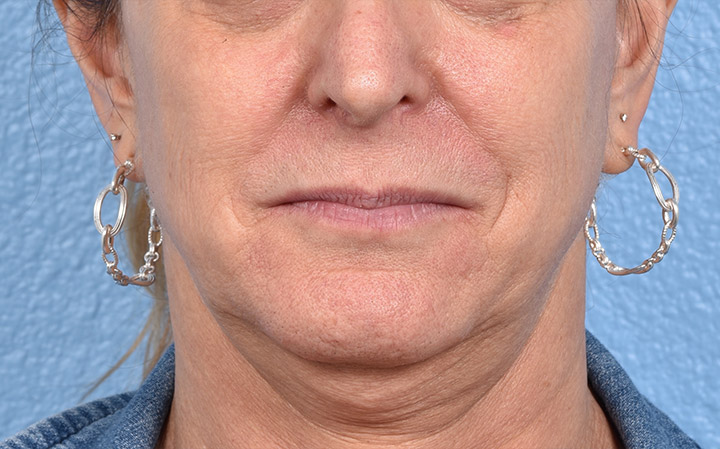 Lip Lift Before & After Gallery - Patient 135816 - Image 1