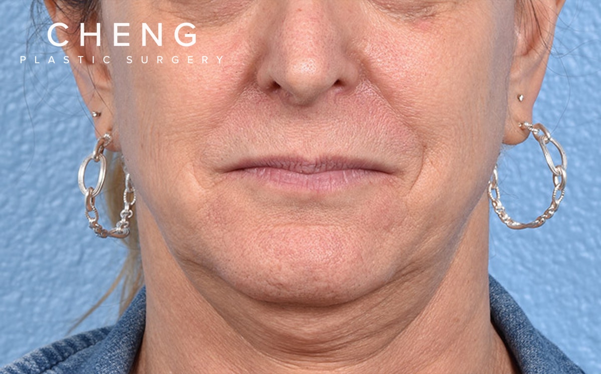 Hidden Patients Before & After Gallery - Patient 265106 - Image 1