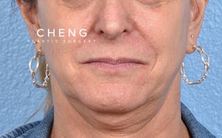 Hidden Patients Before & After Gallery - Patient 265106 - Image 1