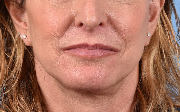 Lip Lift Before & After Gallery - Patient 135816 - Image 2
