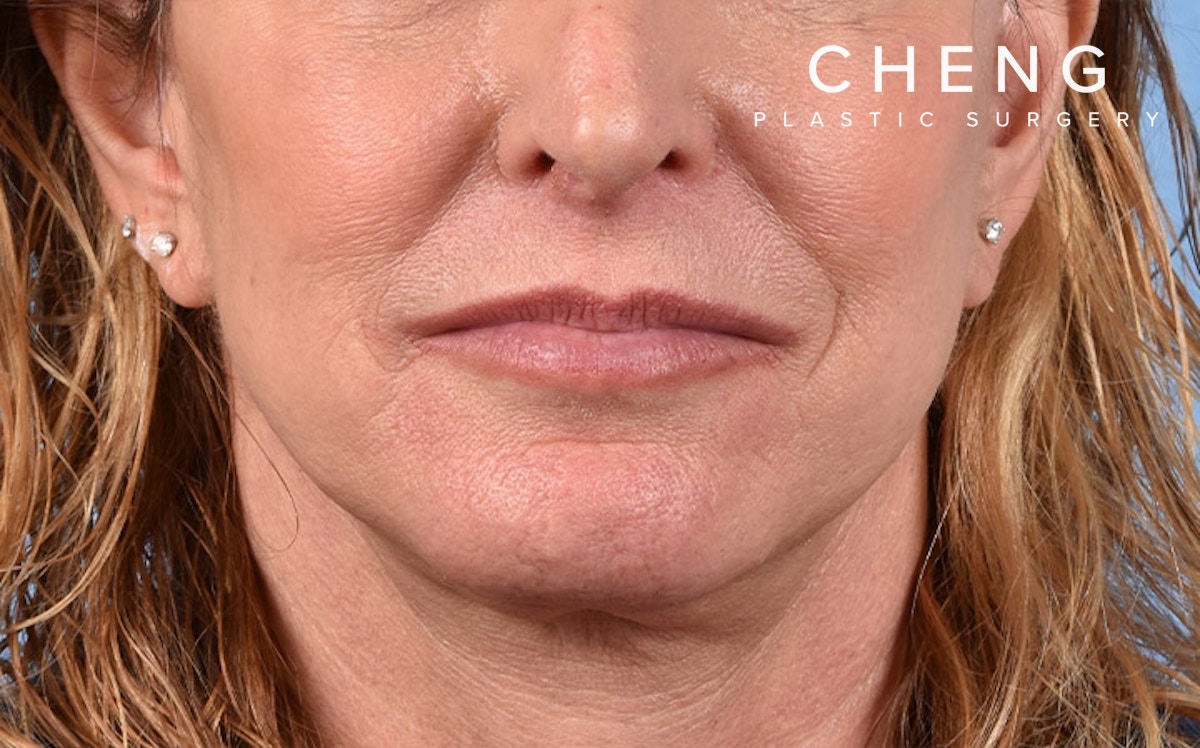 Hidden Patients Before & After Gallery - Patient 265106 - Image 2