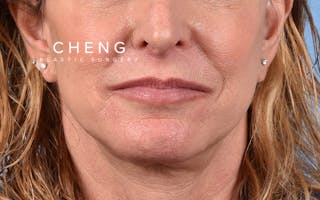 Hidden Patients Before & After Gallery - Patient 265106 - Image 2