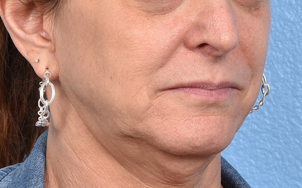Facelift Before & After Gallery - Patient 181853 - Image 3