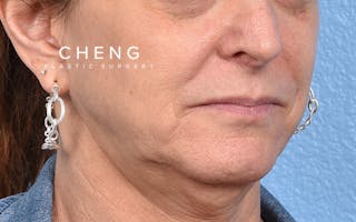 Hidden Patients Before & After Gallery - Patient 265106 - Image 3