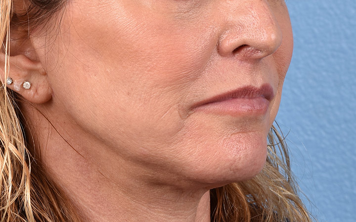 Lip Lift Before & After Gallery - Patient 135816 - Image 4