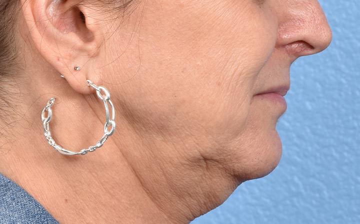 Lip Lift Before & After Gallery - Patient 135816 - Image 5