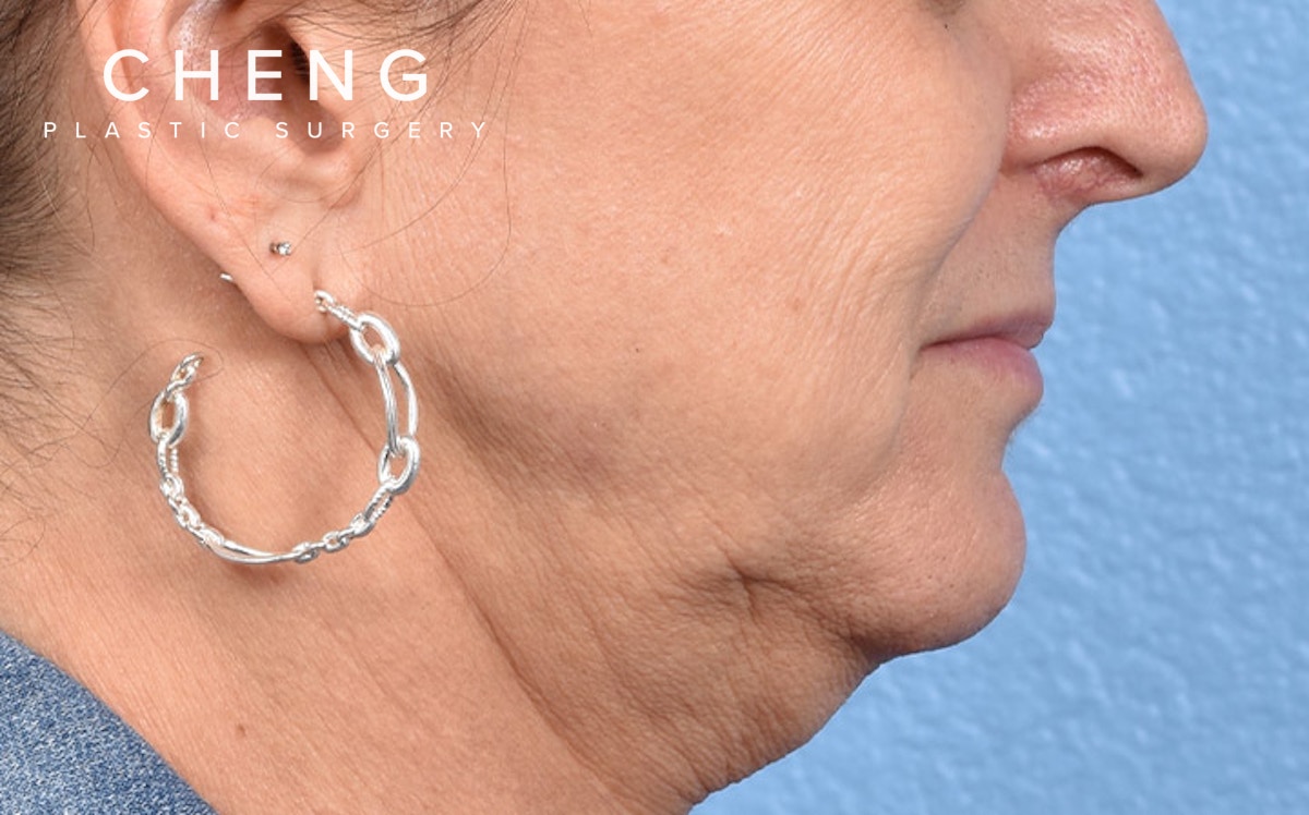 Hidden Patients Before & After Gallery - Patient 265106 - Image 5