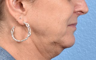 Hidden Patients Before & After Gallery - Patient 265106 - Image 5