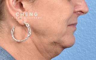 Hidden Patients Before & After Gallery - Patient 265106 - Image 5