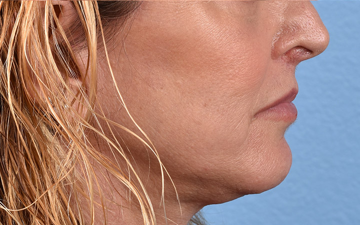 Lip Lift Before & After Gallery - Patient 135816 - Image 6