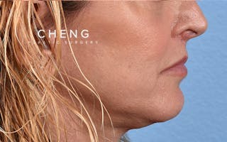 Hidden Patients Before & After Gallery - Patient 265106 - Image 6