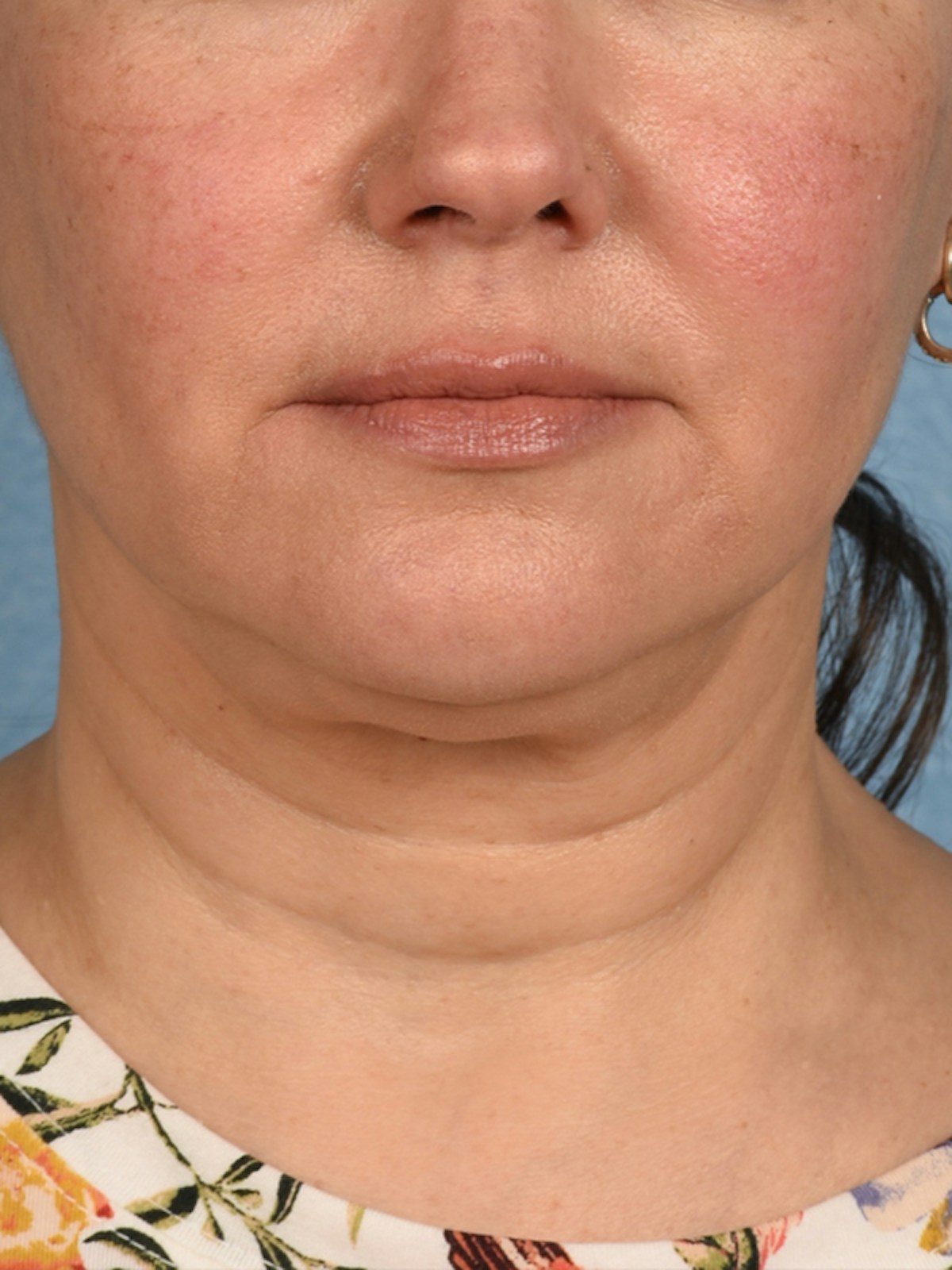 Facelift Before & After Gallery - Patient 545599 - Image 1