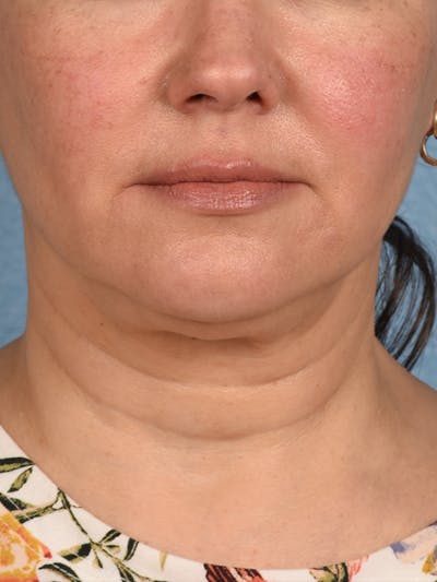 Neck Lift Before & After Gallery - Patient 382090 - Image 1